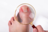 Treatment for Infected Ingrown Toenails